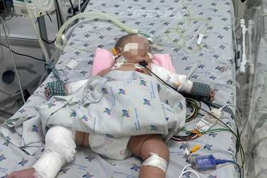 4 ngày sau khi sốt nhẹ, bé gái 5 tháng tuổi sốc sốt xuất huyết nguy kịch