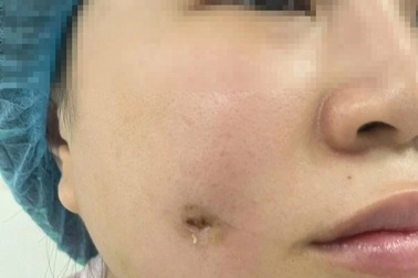 Người phụ nữ bị nhiễm trùng sau khi làm má lúm đồng tiền tại spa