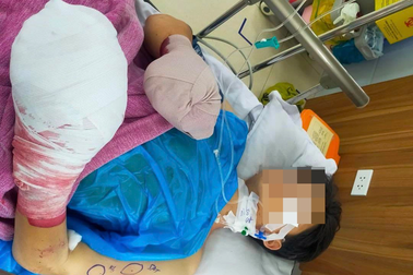 Sau tiếng nổ lớn, cháu bé 14 tuổi nát bàn tay