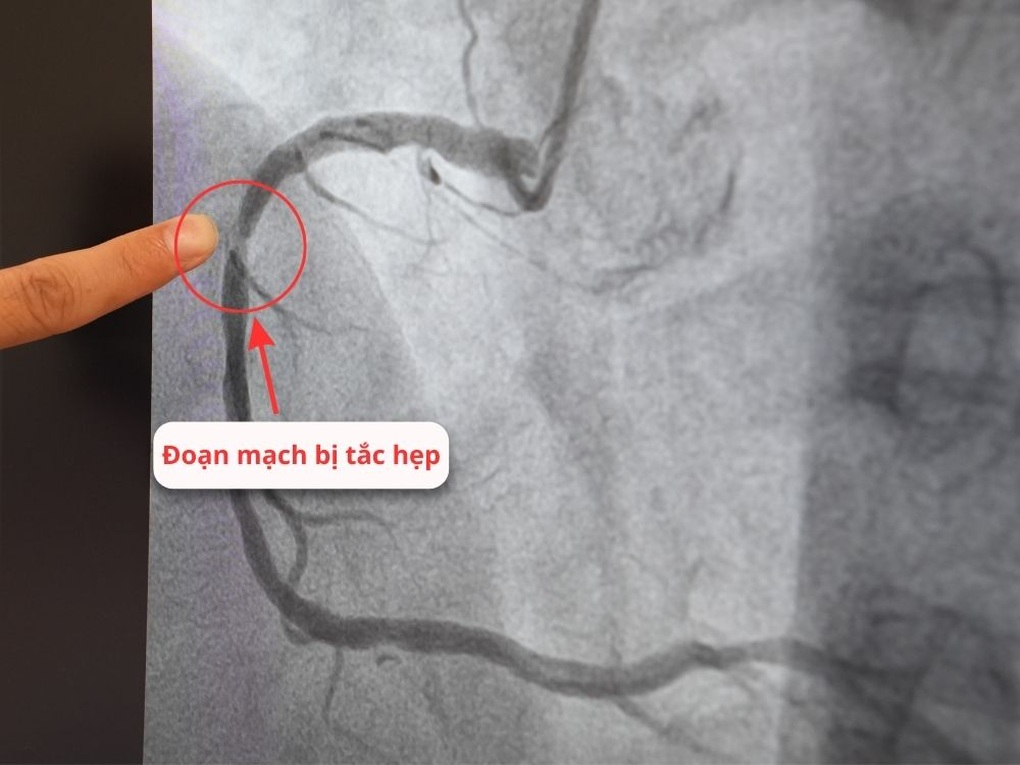 Vượt 100km tới Bệnh viện Hồng Ngọc vì muốn bác sĩ Nguyễn Văn Hải đặt stent - 1 Vượt 100km tới Bệnh viện Hồng Ngọc vì muốn bác sĩ Nguyễn Văn Hải đặt stent - 1
