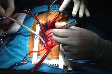 Trái tim “lỗi nhịp” nằm bên phải, bé 3 tuổi thường xuyên đau đớn