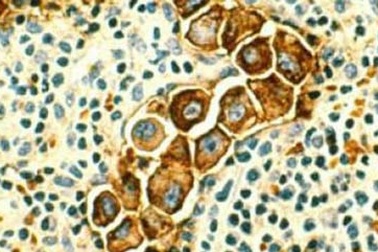 Phát hiện protein gây ung thư di căn