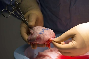 Những nguy cơ khi hiến thận