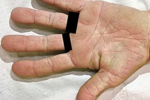 Phát hiện ung thư phổi từ dấu hiệu lạ ở lòng bàn tay