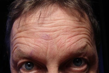 Nếp nhăn trán sâu có thể báo hiệu nguy cơ mắc bệnh tim