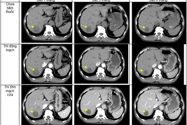 Hà Nội: Nam bệnh nhân mắc 2 bệnh ung thư hạ họng, ung thư gan