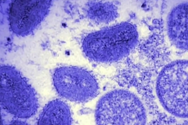 Virus đậu mùa khỉ có thể bám lâu trên các bề mặt trong nhà