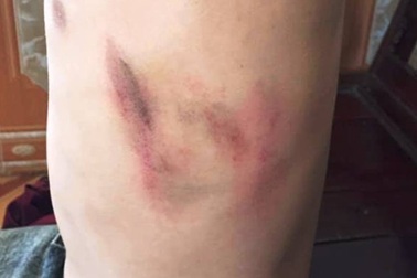 Một học sinh cấp 2 bị phụ huynh hành hung tại trường