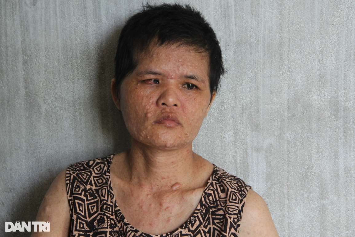 Người mẹ da cóc nuốt nước mắt chịu bệnh tật dày vò dành tiền học cho con - 1 Người mẹ da cóc nuốt nước mắt chịu bệnh tật dày vò dành tiền học cho con - 1