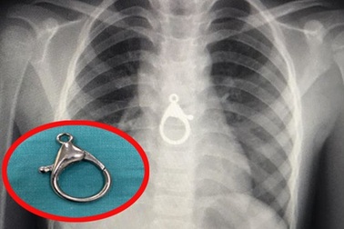 Quảng Nam: Nuốt phải móc khóa, bé 6 tuổi tuổi nhập viện cấp cứu