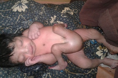 Em bé sinh ra có bốn chân và hai bộ phận sinh dục