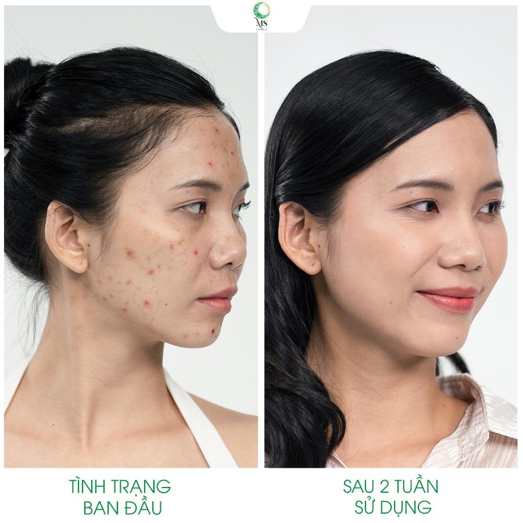 Thanh lăn mụn Ms Cosmetic - Bảo bối giúp giảm sưng viêm và làm khô cồi mụn hiệu quả - 2 Thanh lăn mụn Ms Cosmetic - Bảo bối giúp giảm sưng viêm và làm khô cồi mụn hiệu quả - 2