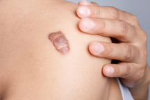 Tự bảo vệ mình khỏi ung thư da với “cẩm nang vàng” từ bác sĩ