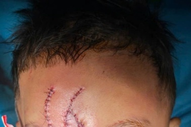 Chơi trước nhà, bé trai 5 tuổi bị chó béc-giê cắn biến dạng mặt nặng nề