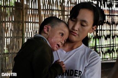 Cậu bé biến dạng khuôn mặt vì ngã vào nước nóng, gần 4 tuổi chưa biết nói