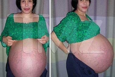 Những bức ảnh gây sốc về bụng bầu của bà mẹ sinh 8