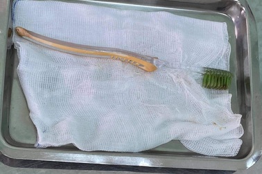 Bé gái 13 tuổi “nuốt chửng” bàn chải đánh răng dài 20cm