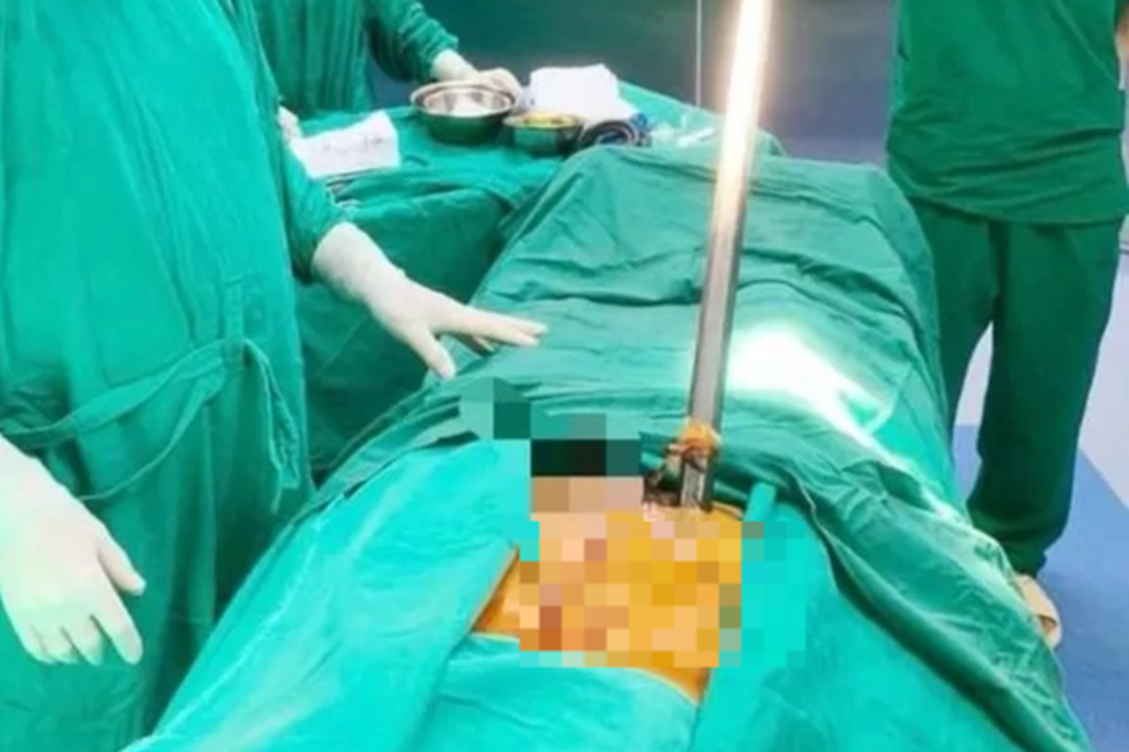 Người đàn ông bị thanh xà beng dài hơn 1m đâm xuyên thành bụng - 1 Người đàn ông bị thanh xà beng dài hơn 1m đâm xuyên thành bụng - 1