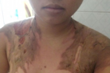 Chồng cầm ấm nước sôi đổ lên người vợ