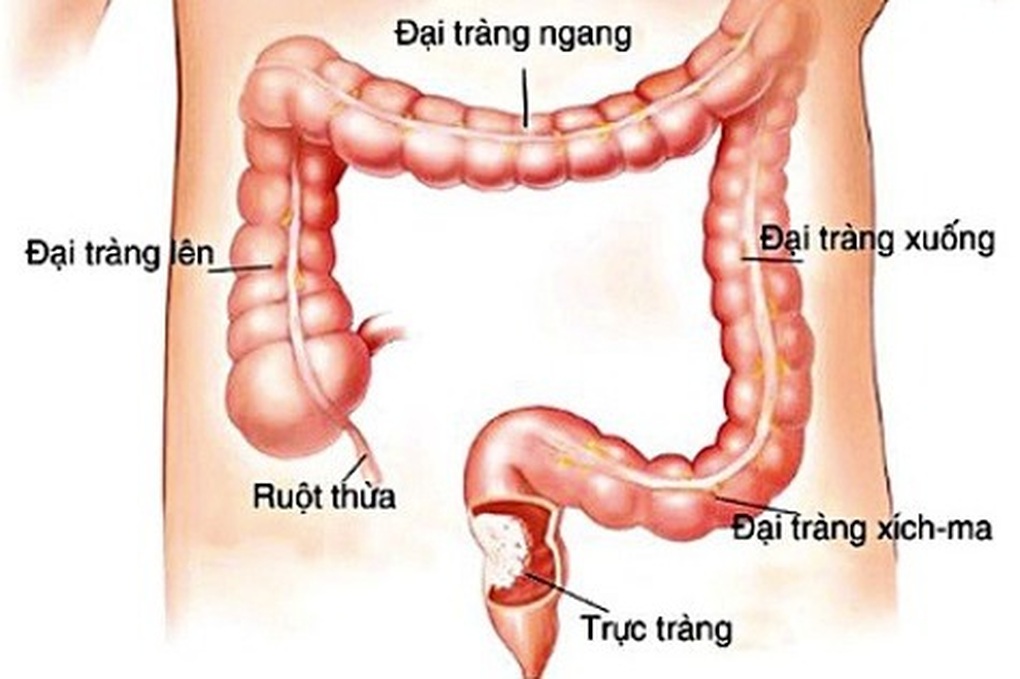 Các triệu chứng của bệnh ung thư trực tràng là gì? - 1 Các triệu chứng của bệnh ung thư trực tràng là gì? - 1