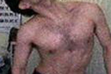 Sảng rượu - Hội chứng không thể xem thường