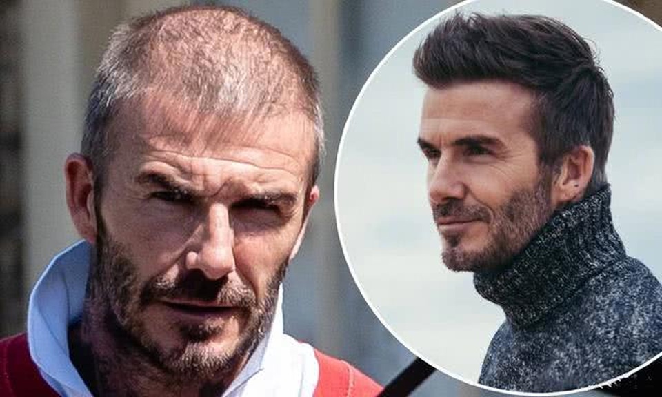 David Beckham đối mặt với chứng rụng tóc và tuổi tác - 1 David Beckham đối mặt với chứng rụng tóc và tuổi tác - 1