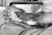 Tường gạch bất ngờ đổ sập, cháu bé 10 tuổi gặp chấn thương nghiêm trọng