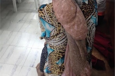 Khối u khủng 4,2 kg "treo" trên người bệnh suốt 35 năm