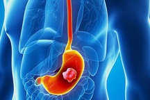 12 nguyên nhân gây ung thư dạ dày được các chuyên gia cảnh báo