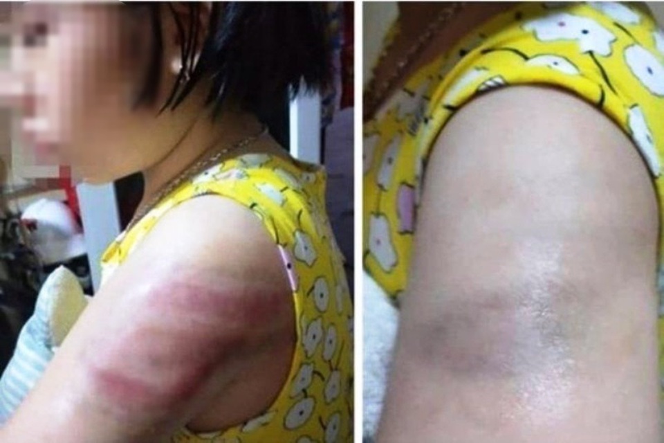 Trần tình của cô giáo dùng thước đánh học sinh lớp 4 bầm tím tay - 1 Trần tình của cô giáo dùng thước đánh học sinh lớp 4 bầm tím tay - 1