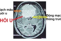 Nhức đầu kéo dài, đi khám phát hiện u não to bằng quả trứng