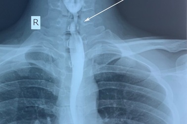 Bỏng thực quản vì uống nhầm chất tẩy rửa