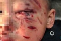 Bé trai 2 tuổi bị chó nhà cắn rách mặt, tổn thương mắt