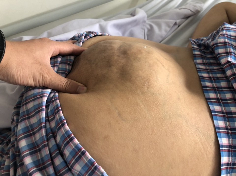 Xót thương cô gái dân tộc Thái suốt 10 năm sống chung với khối u khổng lồ - 3 Xót thương cô gái dân tộc Thái suốt 10 năm sống chung với khối u khổng lồ - 3