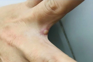 Sức khỏe bệnh nhân mắc đậu mùa khỉ đầu tiên tại Việt Nam hiện ra sao?