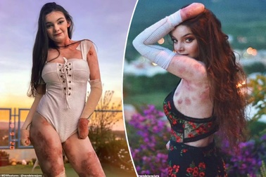 Ước mơ làm người mẫu của cô gái xinh đẹp mắc bệnh "da giấy"