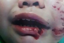 3 cháu bé bị kẻ ngáo đá chém trọng thương, phơi nhiễm HIV