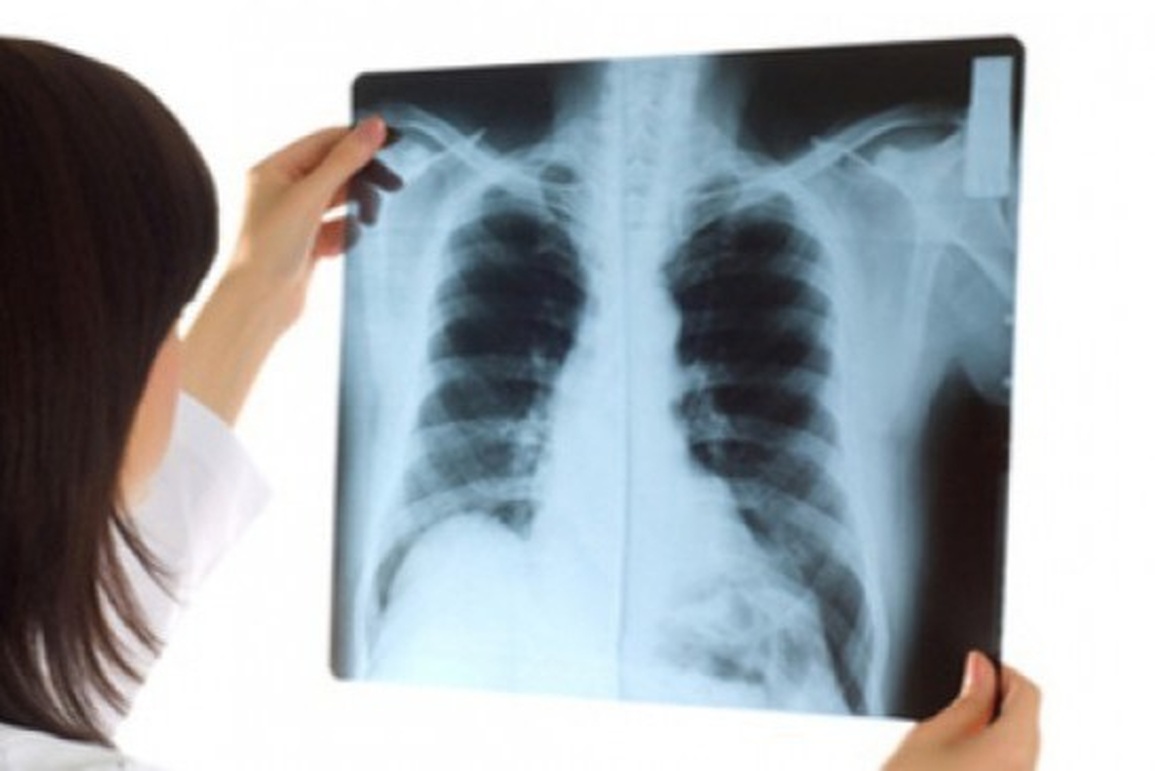 Có những dấu hiệu nào bạn cần nghĩ đến ung thư phổi tế bào nhỏ? - 1 Có những dấu hiệu nào bạn cần nghĩ đến ung thư phổi tế bào nhỏ? - 1