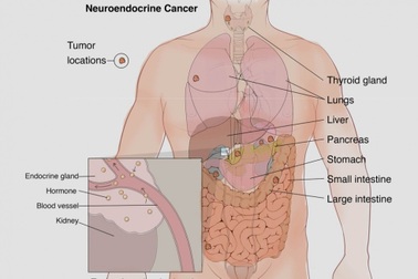 Triệu chứng của khối u thần kinh nội tiết