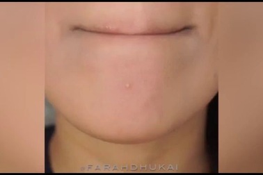 Trị mụn với 1 nhánh tỏi