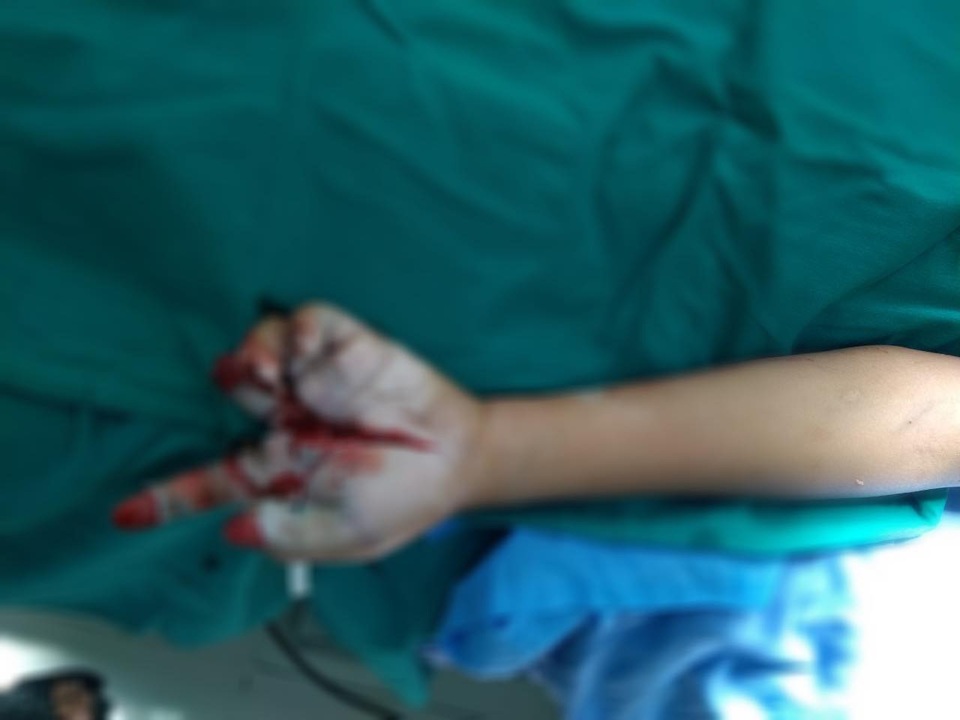Bé trai 11 tuổi chi chít vết thương do tai nạn pháo nổ - 1 Bé trai 11 tuổi chi chít vết thương do tai nạn pháo nổ - 1