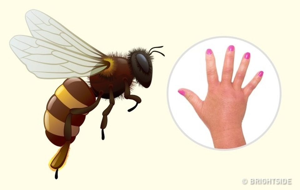 Cách phân biệt 10 vết côn trùng cắn - 1 Cách phân biệt 10 vết côn trùng cắn - 1
