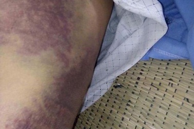 Kinh hoàng bố bị con trai đánh bầm dập, gãy xương sườn, mẻ bánh chè