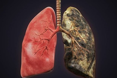 Chỉ dấu sinh học giúp chẩn đoán sớm ung thư phổi