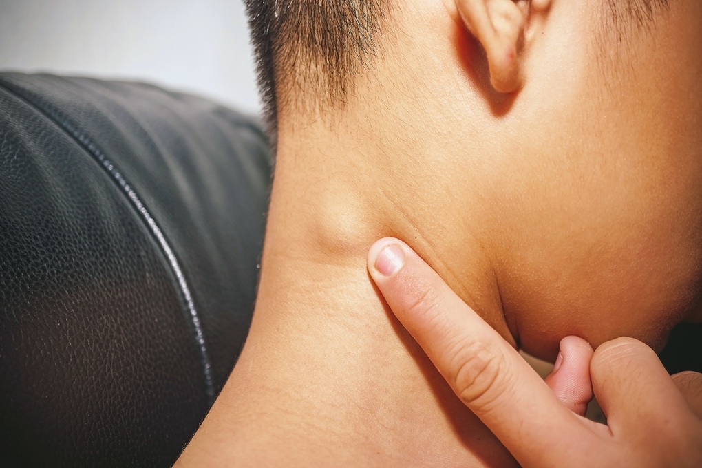 Có 5 triệu chứng này cần cảnh giác với ung thư hạch - 1 Có 5 triệu chứng này cần cảnh giác với ung thư hạch - 1