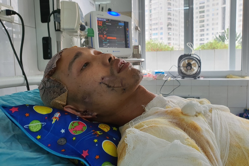 Chàng trẻ nguy kịch sau vụ tai nạn thương tâm mất nửa phần da cơ thể - 5 Chàng trẻ nguy kịch sau vụ tai nạn thương tâm mất nửa phần da cơ thể - 5
