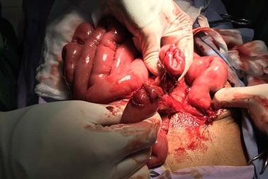 Cứu sống bệnh nhân bị đứt ruột non do tai nạn lao động