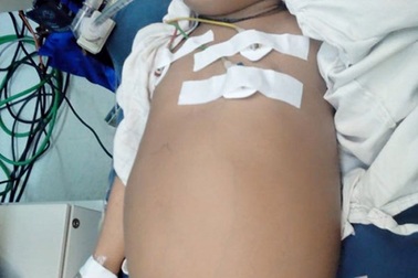 Mổ thành công khối u khổng lồ cho bé gái người Lào