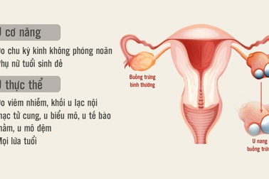[Inforgraphics]: Phát hiện sớm u nang buồng trứng