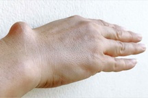 U xương lành tính có nguy hiểm không?